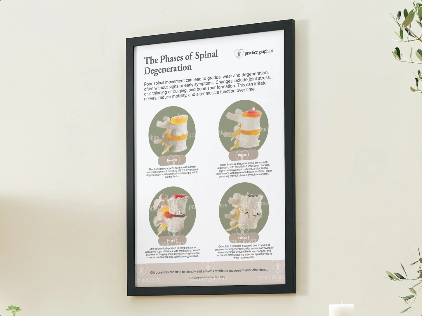 Phases of spinal degeneration Poster (Spinal Model)