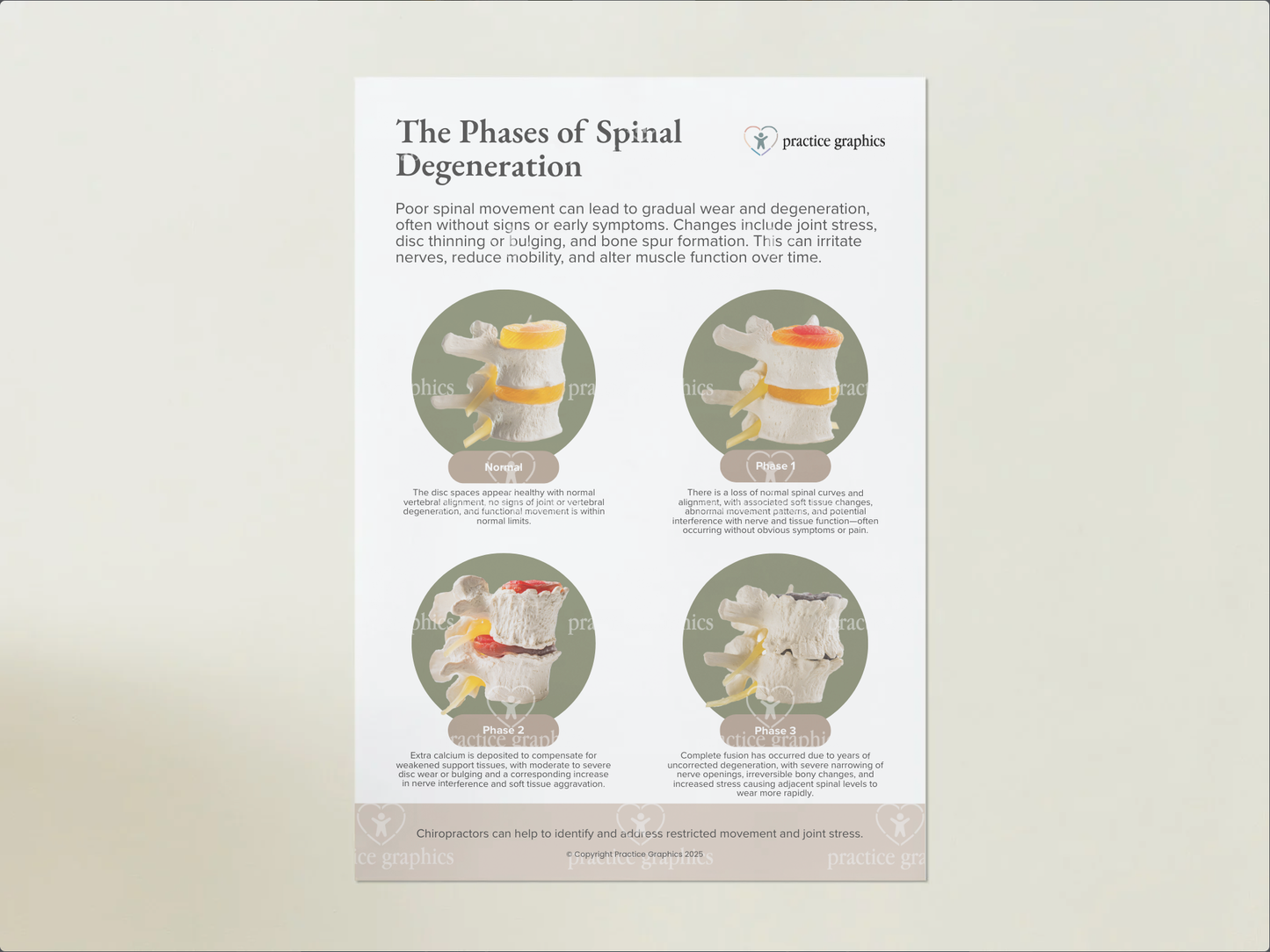 Phases of spinal degeneration Poster (Spinal Model)