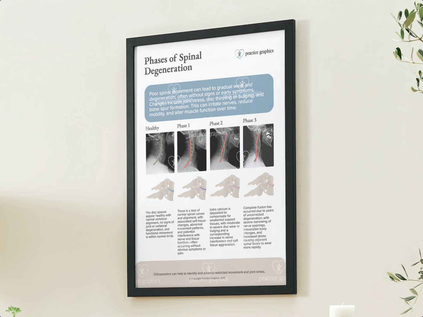 Phases of spinal degeneration Poster (xrays)