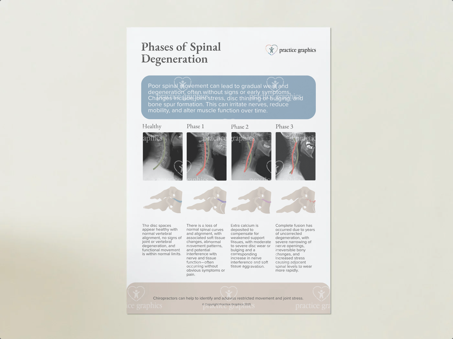Phases of spinal degeneration Poster (xrays)
